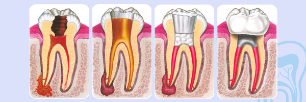 Endodontry